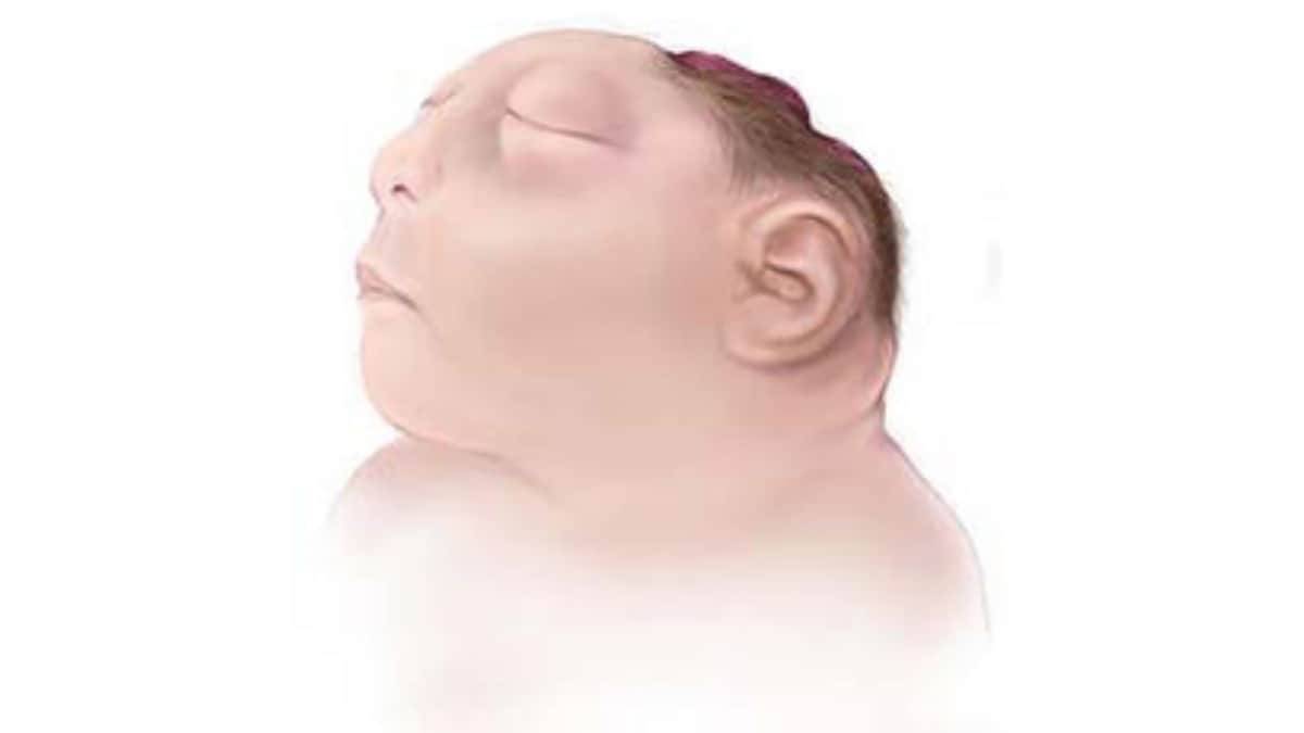 Illustration of infant with anencephaly.