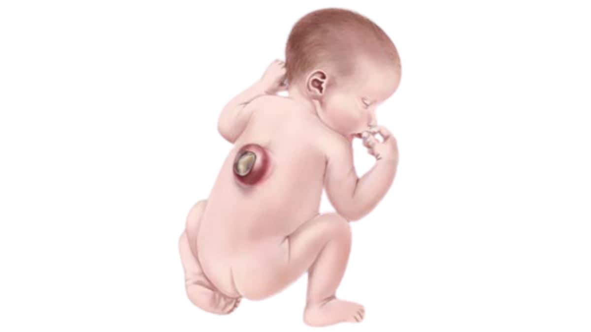 Illustration of infant with spina bifida.
