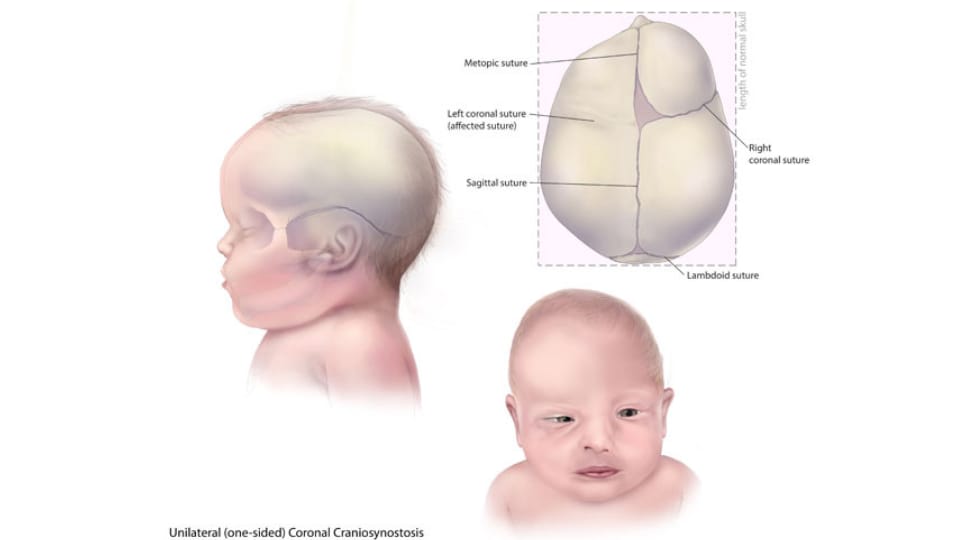 Illustration of Infant with Unilateral (one-sided) Coronal Craniosynostosis