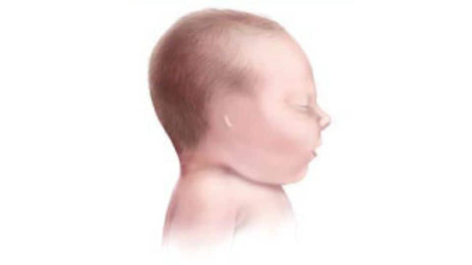 Illustration of infant with anotia: no external ear.