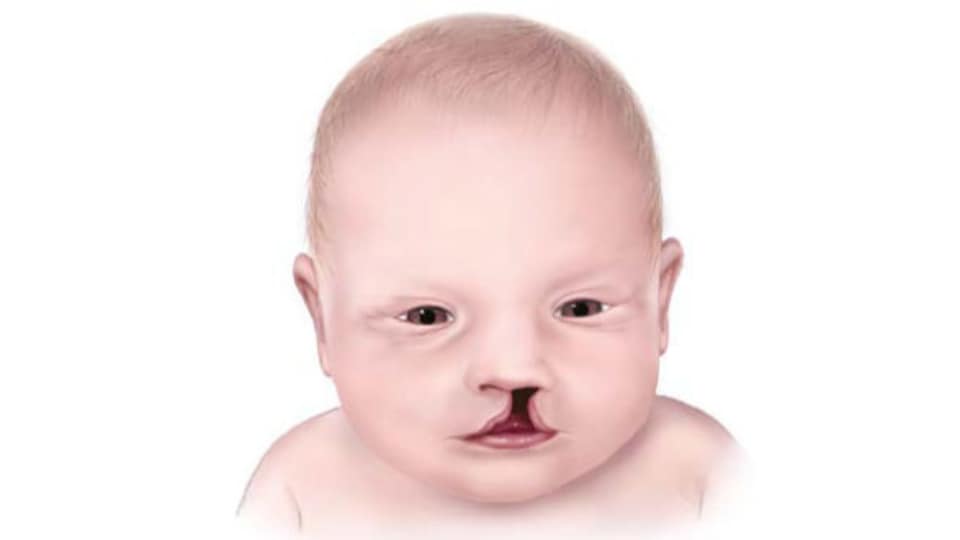 Illustration of infant with a cleft lip