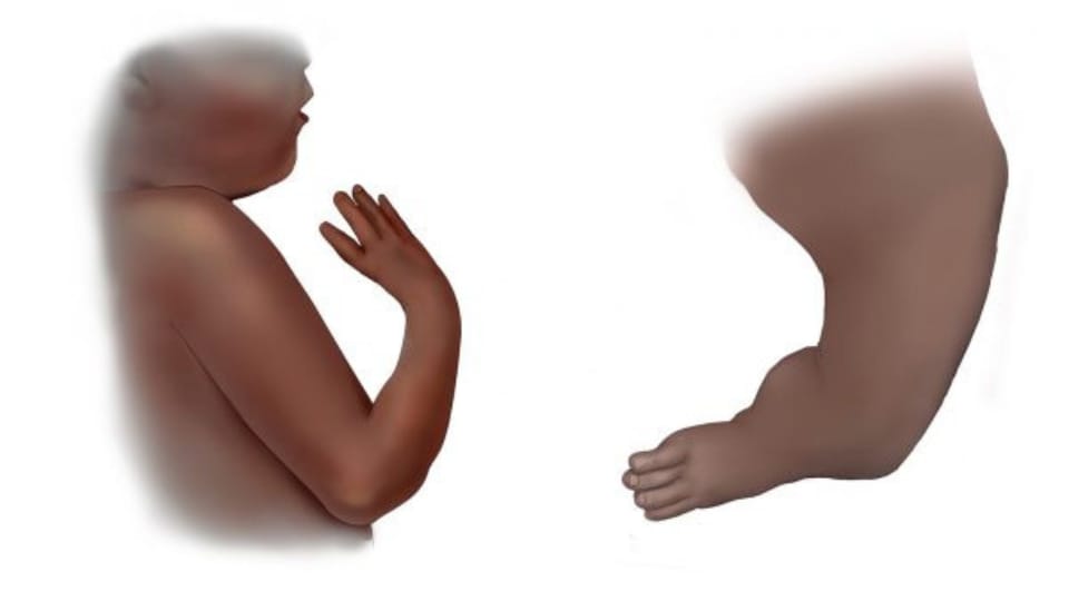 Illustration of infant with upper and lower reduction defects.