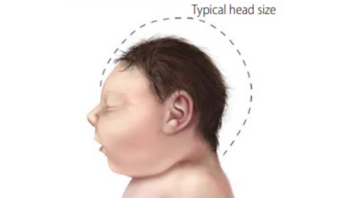 Illustration of baby with microcephaly, with a dotted outline showing the shape of a typical sized head for comparison.