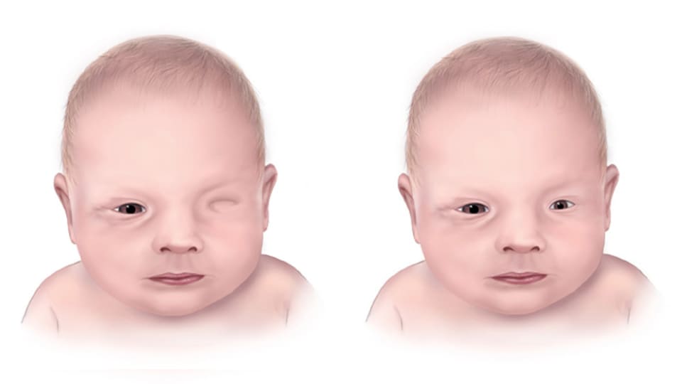 Illustration of two babies with anophthalmia. One baby is missing one eye and the other baby has microphthalmia, where one eye is very small.