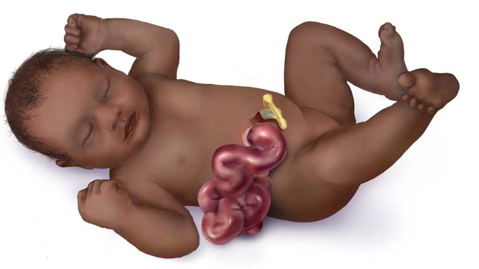 Medical illustration of an infant with gastroschisis.