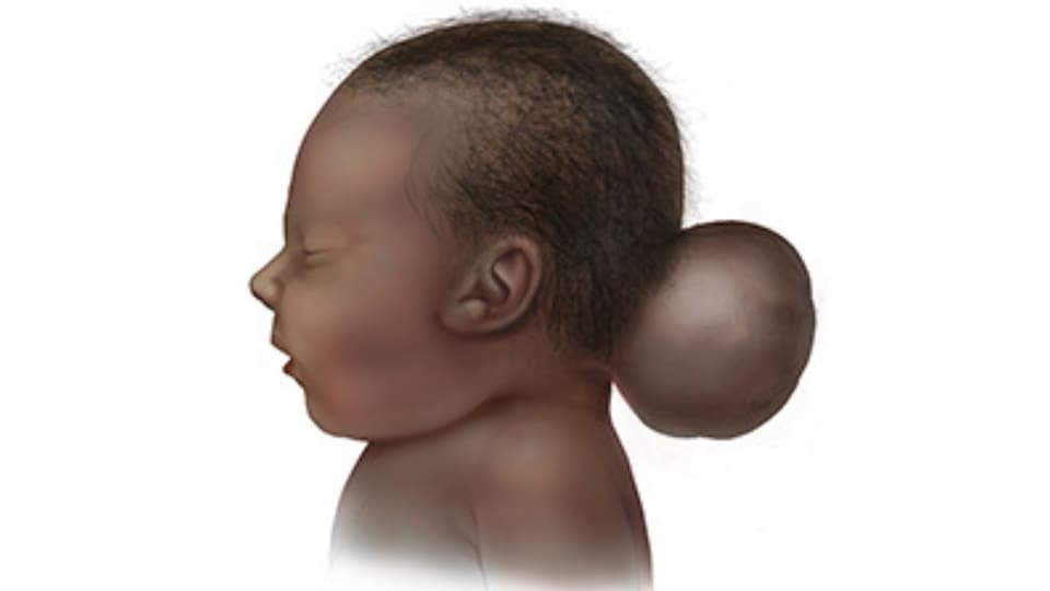 Illustration of infant with occipital encephalocele.
