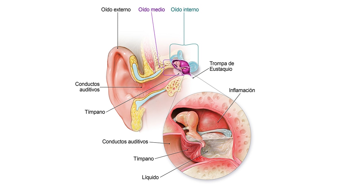 Diagrama de la anatomía del oído que muestra dónde se acumula el líquido en el oído medio y dónde ejerce presión.