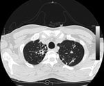 Thumbnail of Computed tomography image of chest of patient with tuberculosis after anti–hepatitis C virus therapy. A parenchymal distortion 32 mm in diameter is shown in the upper right lung with initial central excavation 10 mm in diameter (horizontal arrow). Similar lesions 8 mm in diameter without central excavation are shown in the upper left lung (vertical arrow).