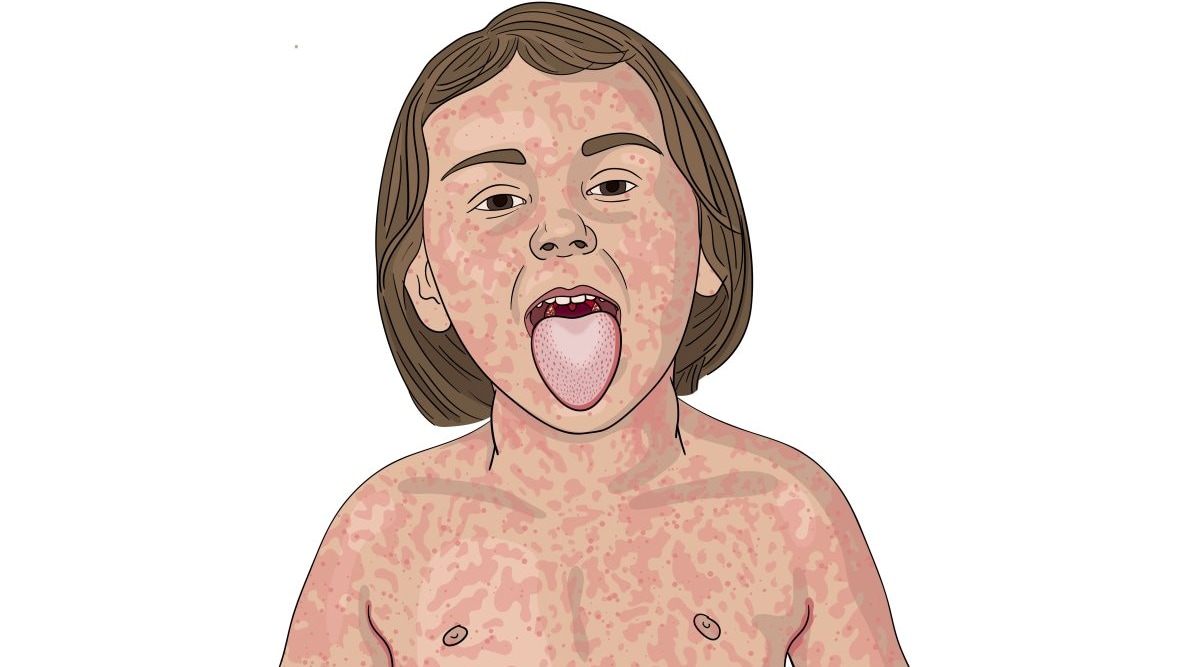 A illustration of a young child with a rash indicative of scarlet fever.