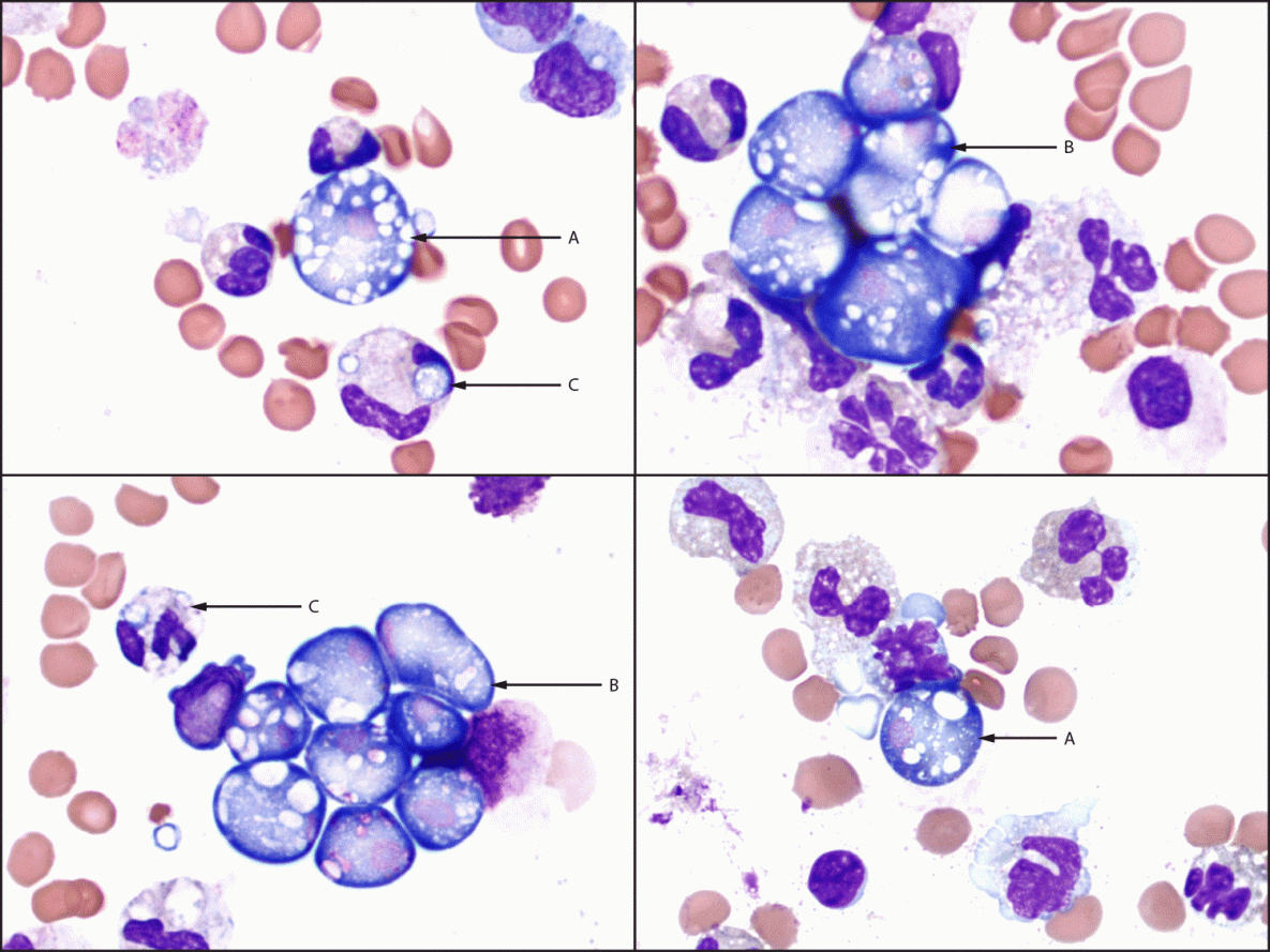 The figure is a set of four Wright-Giemsa stained (x1,000 magnification) cerebrospinal fluid cytospin slide images from a patient with fatal primary amebic meningoencephalitis, demonstrating numerous Naegleria fowleri trophozoites seen as extracellular single forms or clusters, with a predominantly neutrophilic background inflammatory response including neutrophils phagocytizing N. fowleri microorganisms in Pulaski County, Arkansas, in September 2023.
